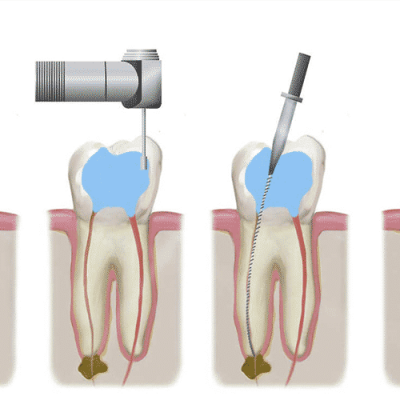 Болить зуб після пломбування каналів